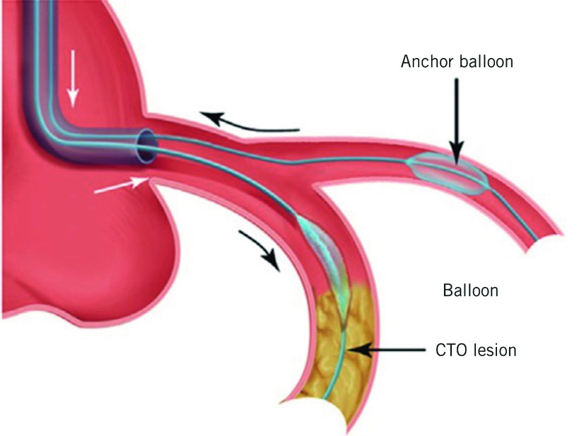 Complex Bifurcation Stenting & CTO Stenting