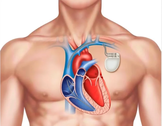 Pacemaker Implantation