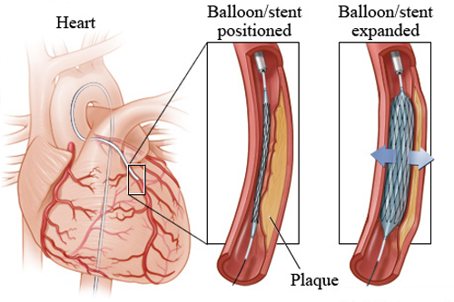 Primary Angioplasty