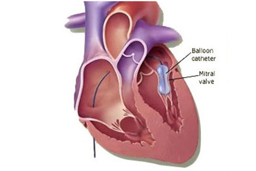 BMV (Balloon Mitral Valvuloplasty)