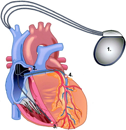 CRT-D (Cardiac Resynchronization Therapy—Defibrillator)