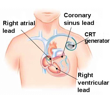 CRT-P (Cardiac Resynchronization Therapy - Pacemaker)