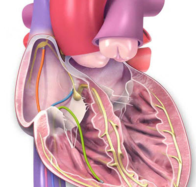 Electrophysiology Study