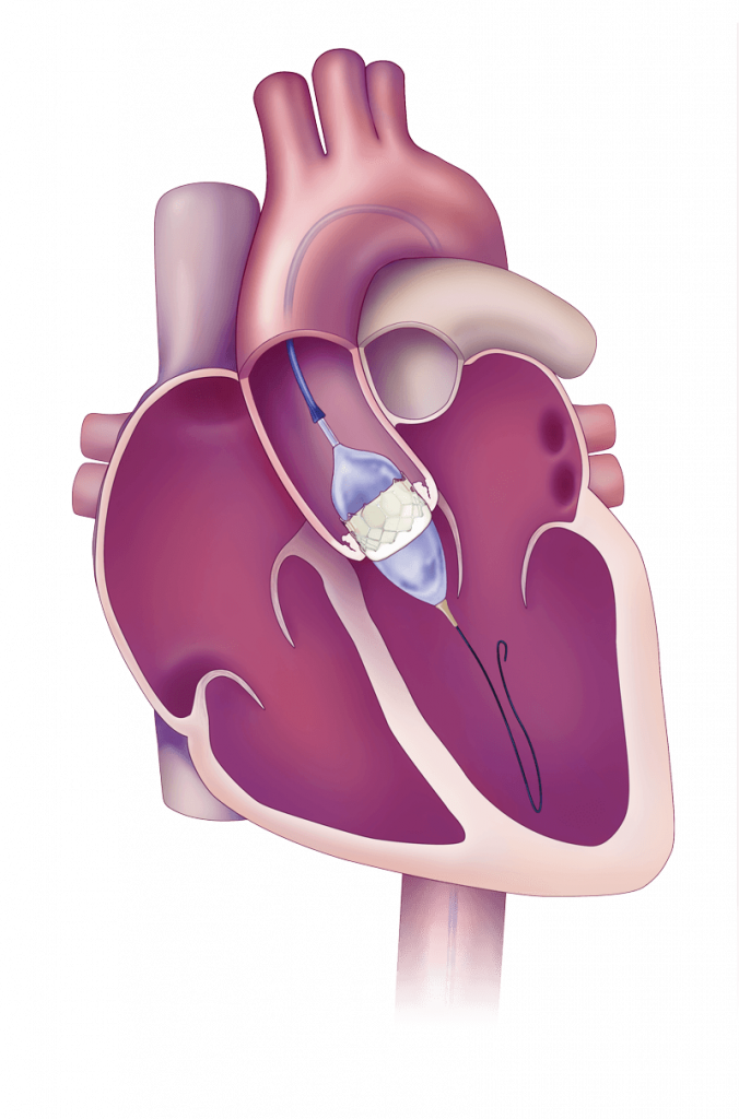 TAVI (Transcatheter Aortic Valve Implantation)